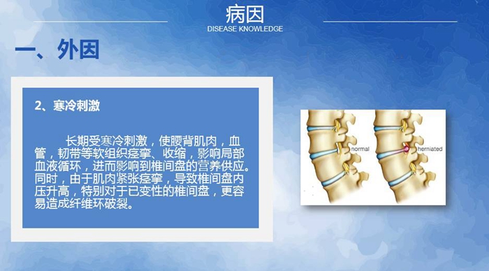 國(guó)康健康保險(xiǎn)談腰椎間盤(pán)突出