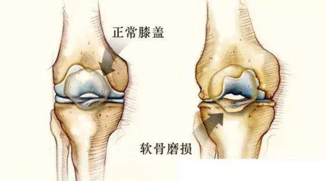 跑步有益健康，但膝蓋你得省著點(diǎn)用，告訴你幾個護(hù)膝小妙招！