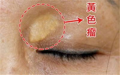 不體檢也能看出血脂異常？告訴你三種判斷血脂異常的征兆