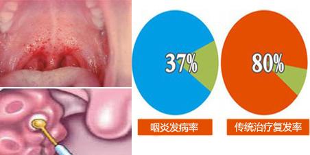 慢性咽炎——你要這樣消滅喉嚨里的這把“虛火”