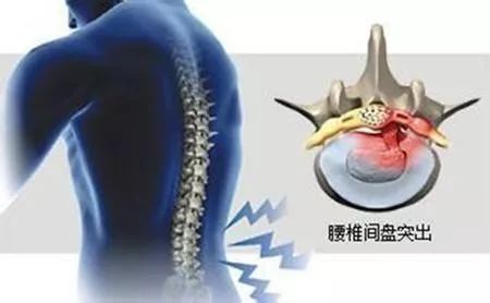 國(guó)康健康保險(xiǎn)談腰椎間盤(pán)突出