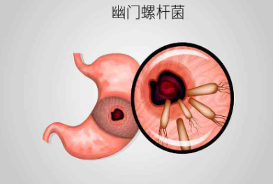 舌尖上的幽門(mén)螺桿菌