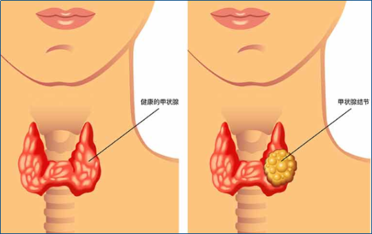 體檢查出甲狀腺結(jié)節(jié)應(yīng)該怎么辦？不復(fù)查真的會癌變嗎？一文講清楚